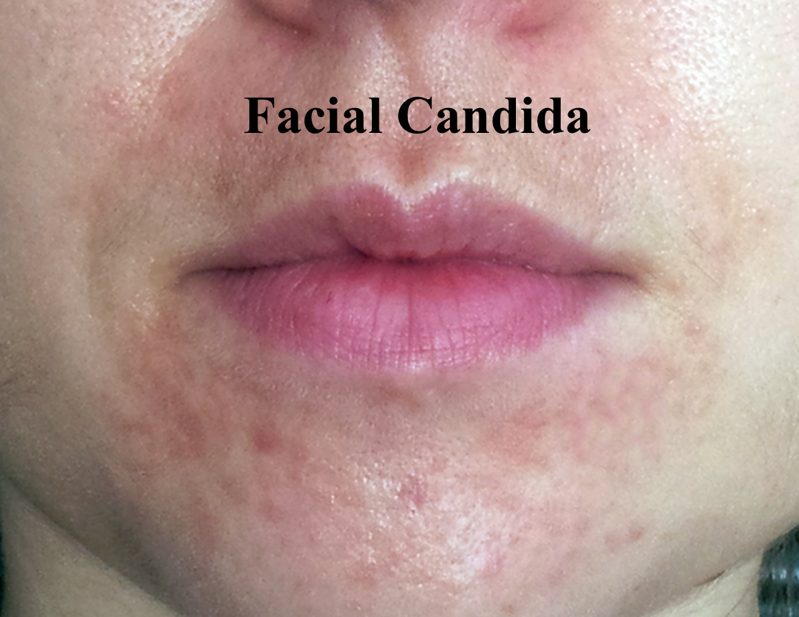 Candida Of The Skin Facial Yeast And How It Can Occur Lea Eigard 