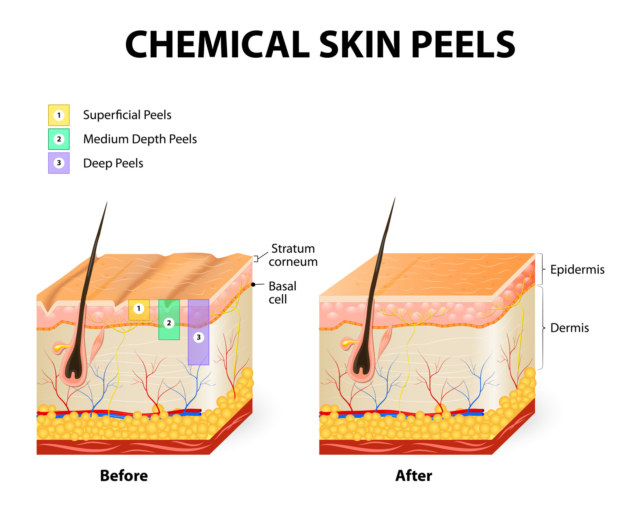 A diagram of chemical peels showing how they work.