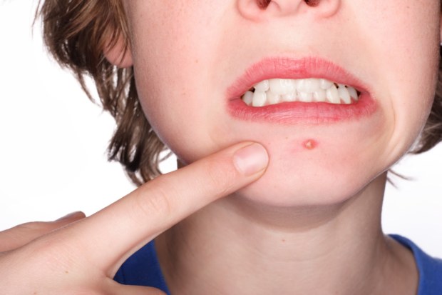 A person with acne on their face and finger pointing to it.