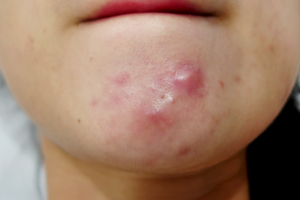 A close up of the face with acne on it