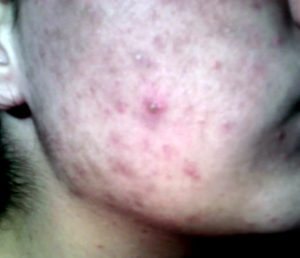 A close up of the face with acne on it