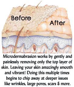 A picture of the inside of a microdermabrasion machine.