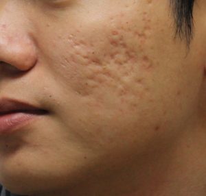 A close up of a person with acne on their face