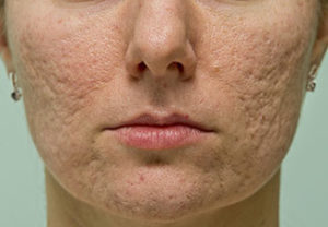 A woman with acne on her face and chin.