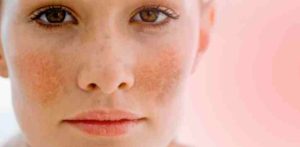 A close up of a person with brown spots on their face