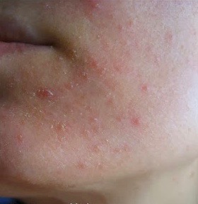 yeast infection on face